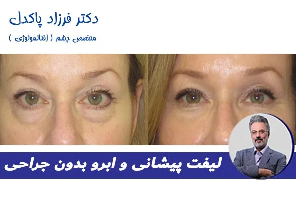 عکس قبل و بعد لیفت پیشانی و ابرو