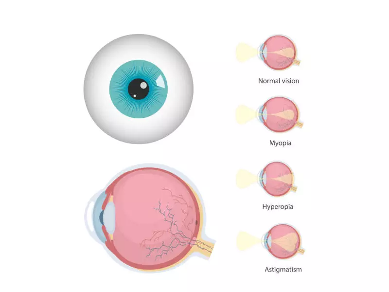 بیماری عیوب انکساری چشم چیست؟