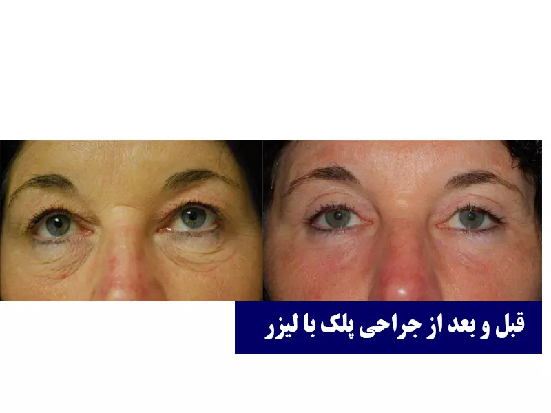 قبل و بعد از جراحی پلک با لیزر در تهران