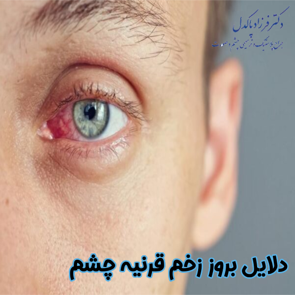 دلایل بروز زخم قرنیه چشم