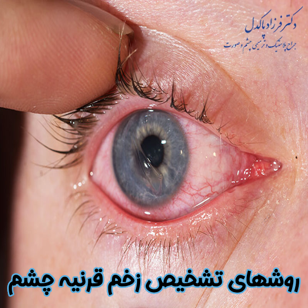 روشهای تشخیص زخم قرنیه چشم