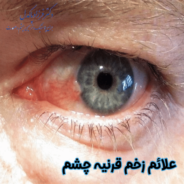 علائم زخم قرنیه چشم