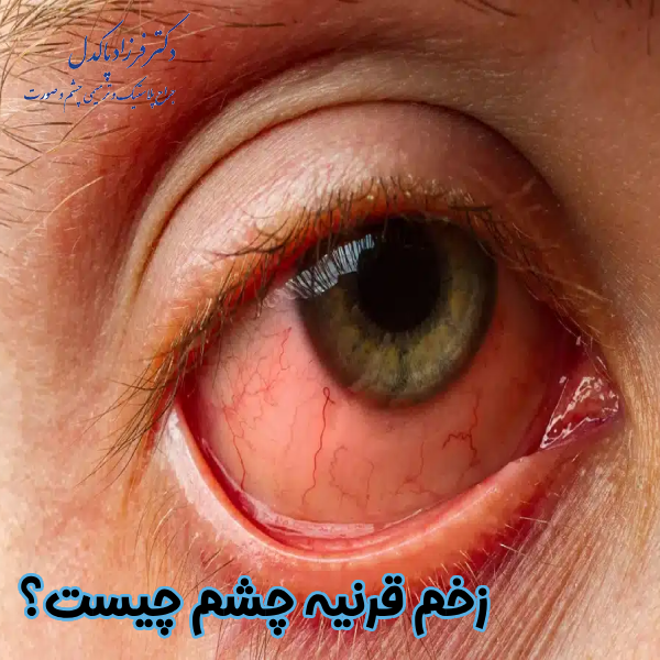 زخم قرنیه چشم چیست