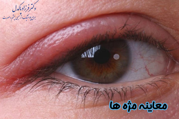 معاینه مژه‌ ها