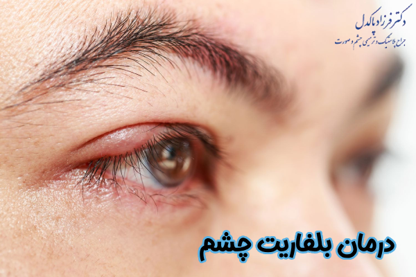 روشهای درمان بلفاریت چشم