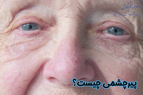 بیماری پیرچشمی چیست